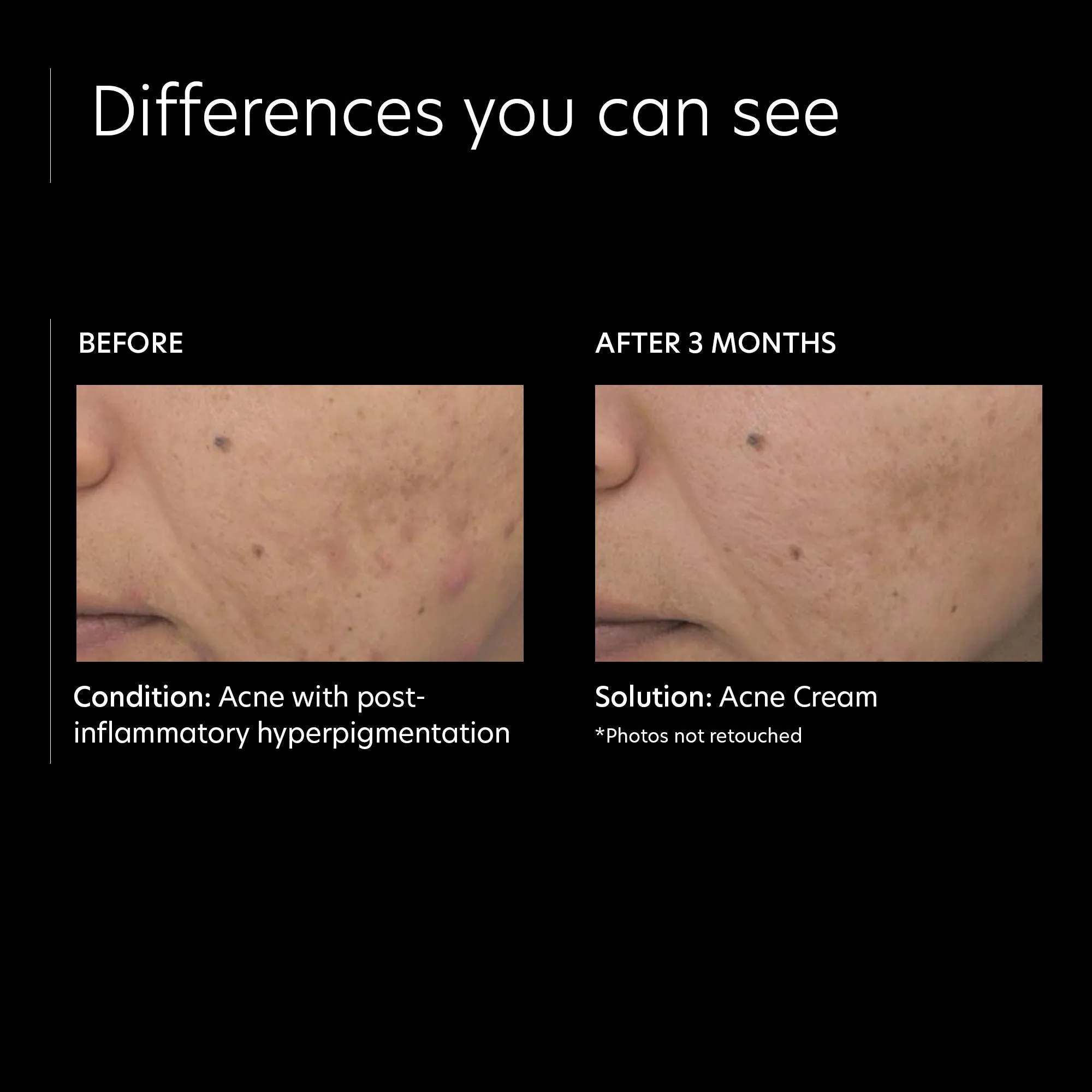 Acne Cream
