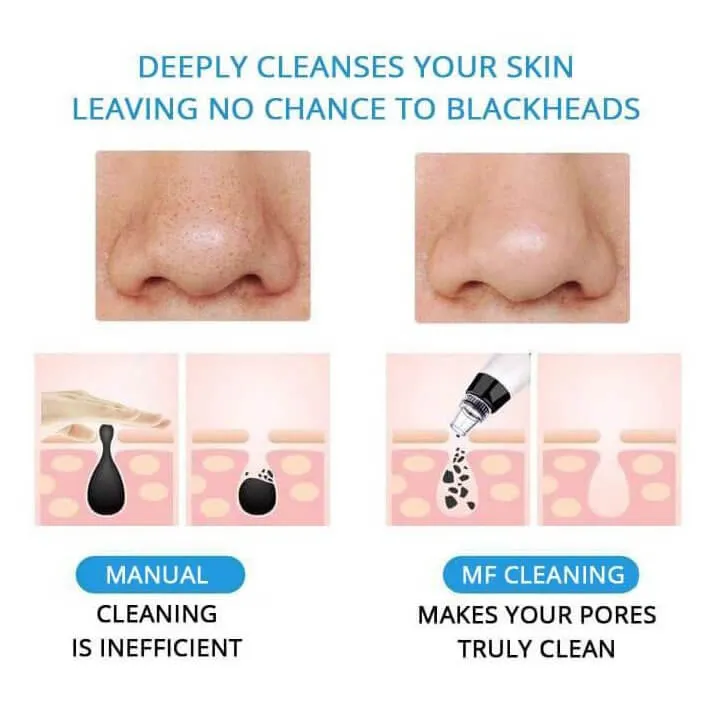 Vacuum Pore Cleanser