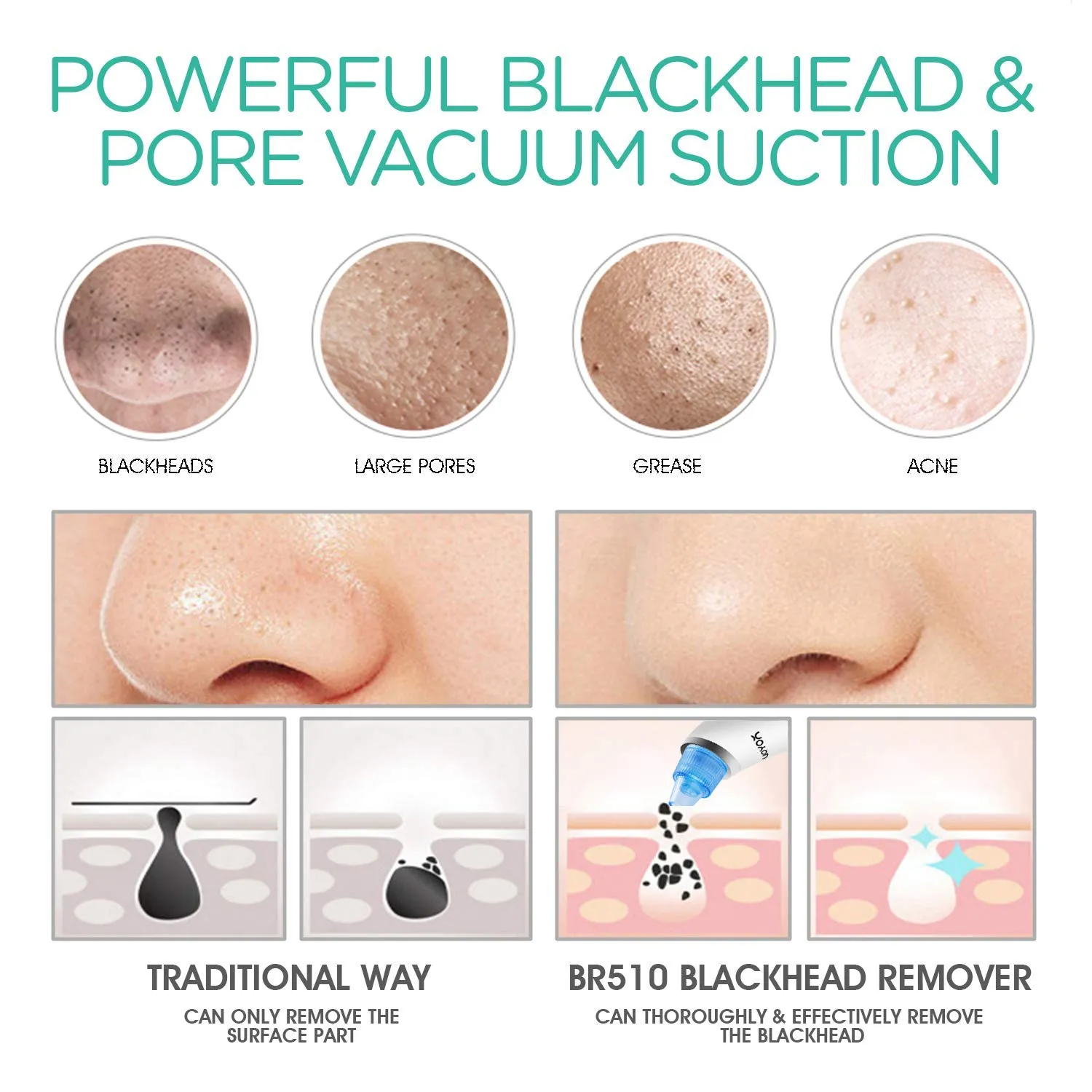 VOYOR Blackhead Remover Pore Vacuum - Blackheads Remover Tools Electric Face Vacuum Pore Cleaner Acne Whiteheads Extractor with 6 Suction Heads and 5 Suction Levels for Men and Women BR510